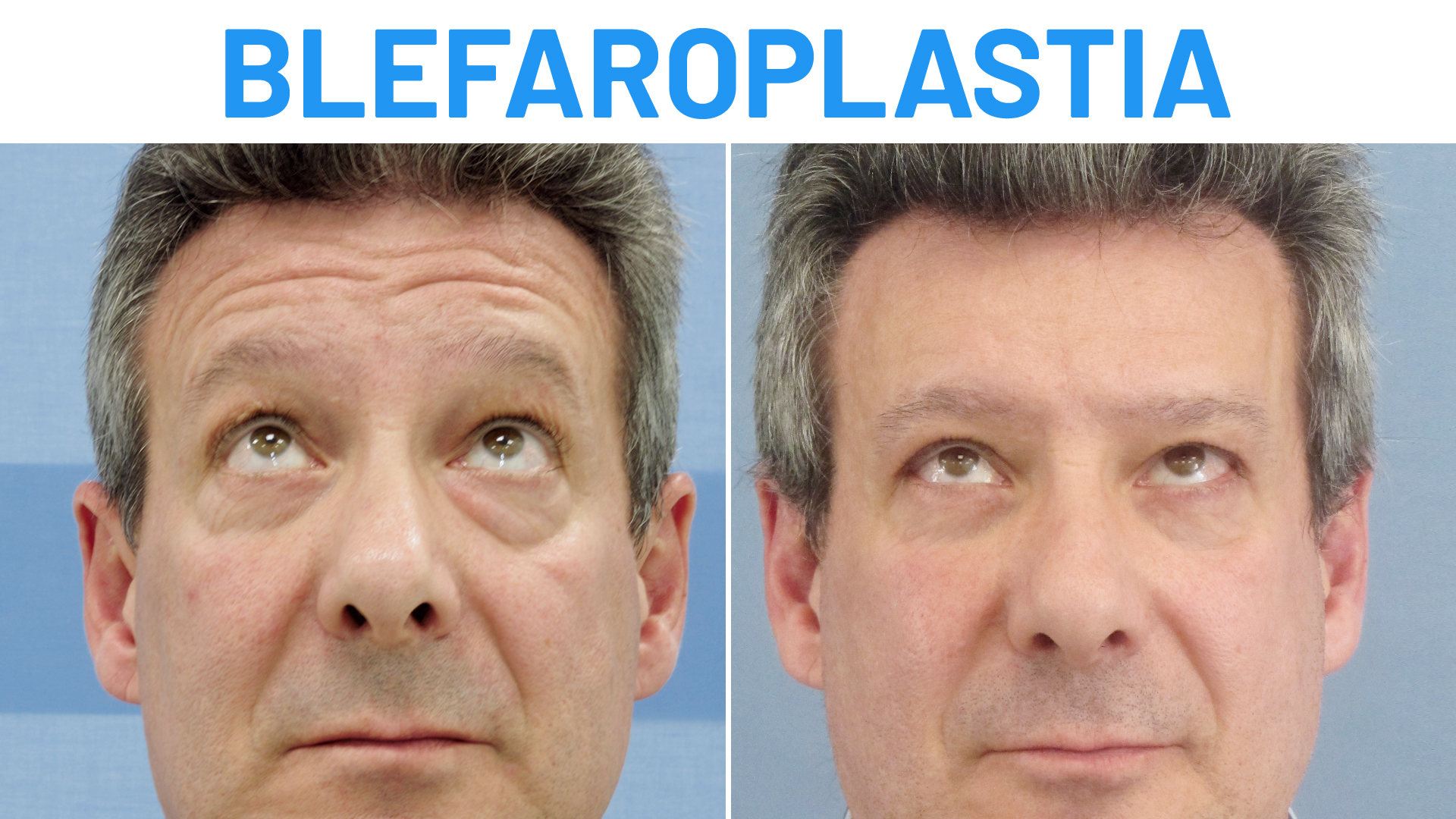 Blefaroplastia Resultados Recomendaciones Y Gu A