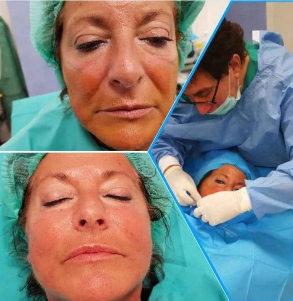 blefaroplastia bilbao opiniones