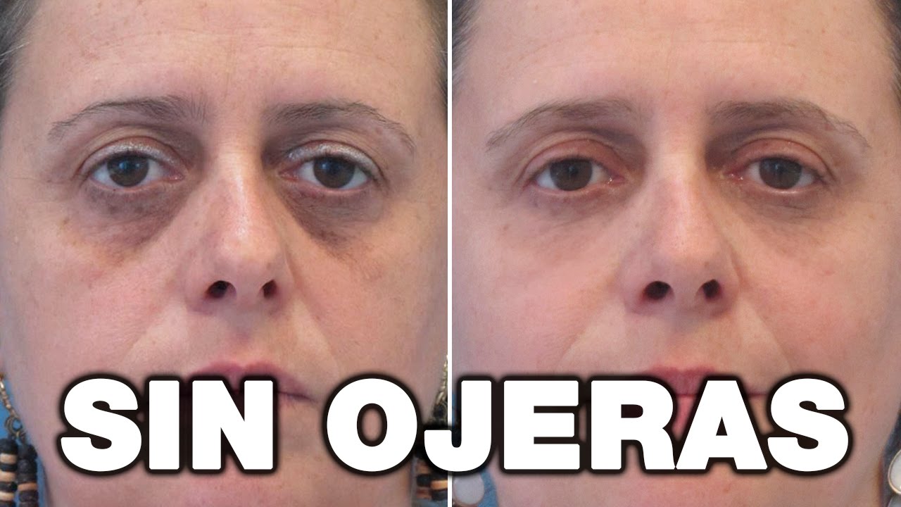 Blefaroplastia Ojeras Recomendaciones Y Guía 2019 Blefaroplastia Ojeras Recomendaciones Y Guía 2019