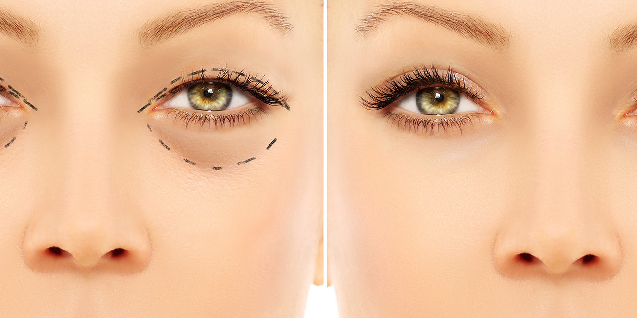 Blefaroplastia Ojeras Recomendaciones Y Guía 2019 Blefaroplastia Ojeras Recomendaciones Y Guía 2019