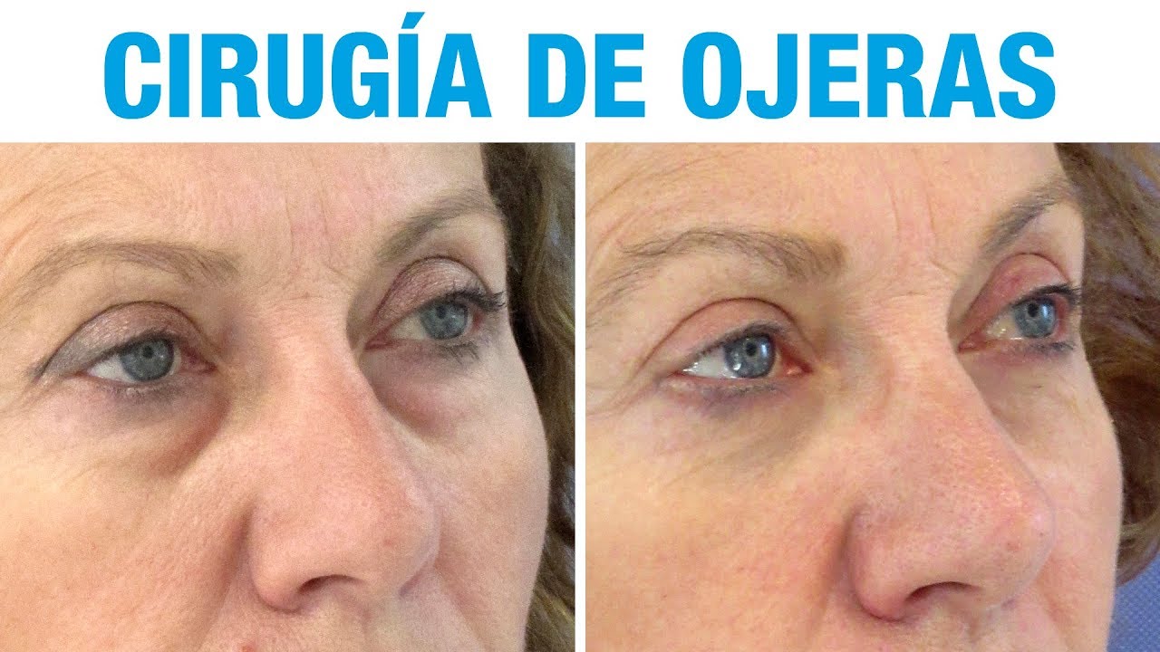 Blefaroplastia Ojeras Recomendaciones Y Guía 2019 Blefaroplastia Ojeras Recomendaciones Y Guía 2019