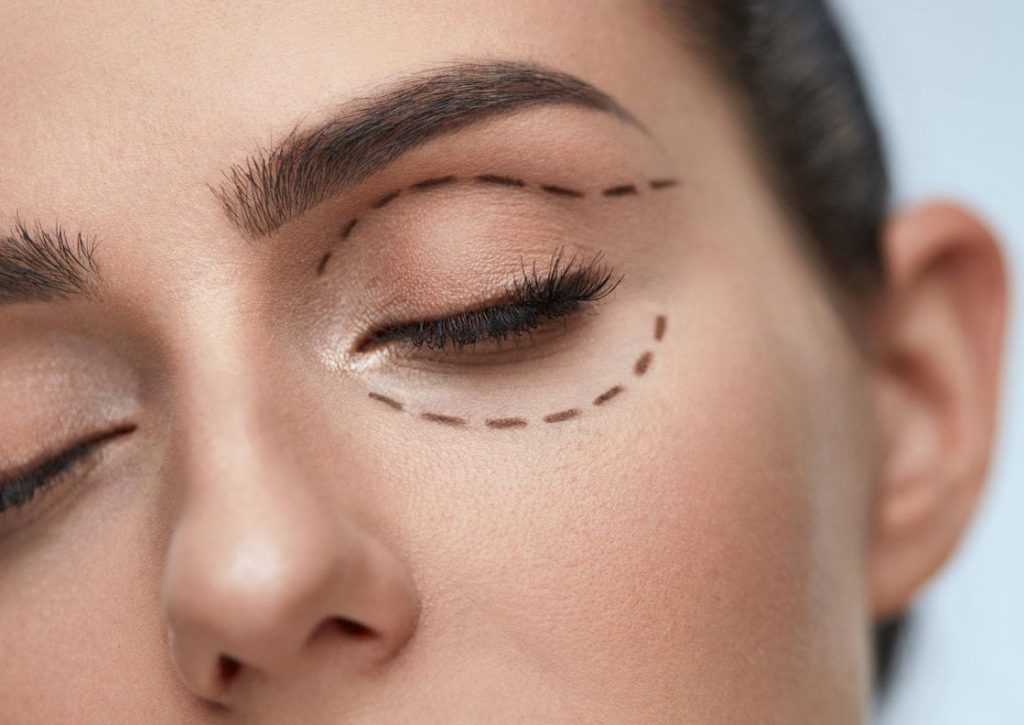 que es blefaroplastia transconjuntival
