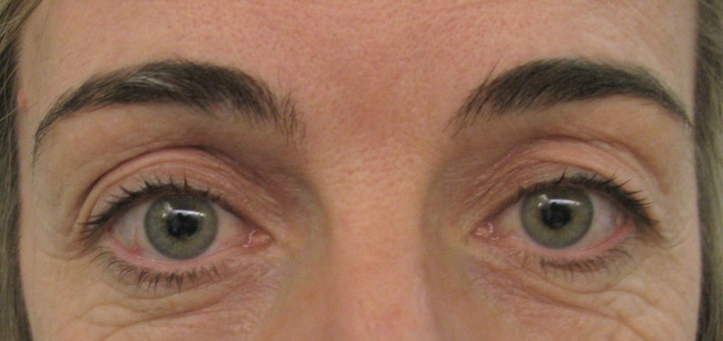 blefaroplastia funcional