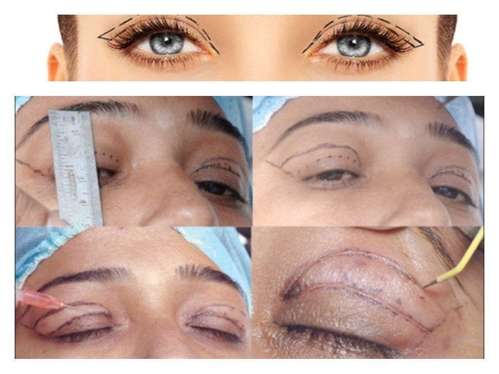 blefaroplastia precio